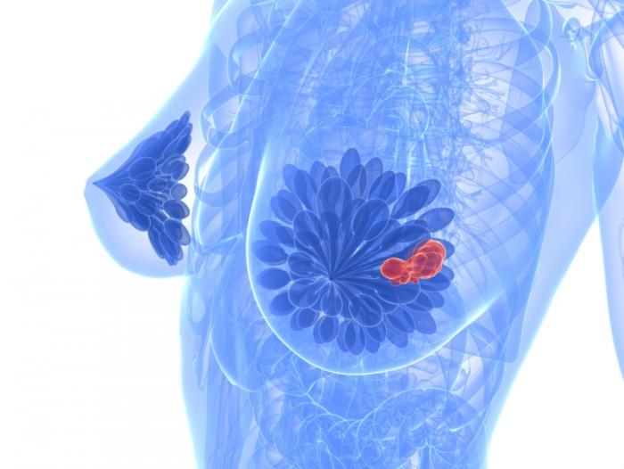 breast-cancer-cells.jpg